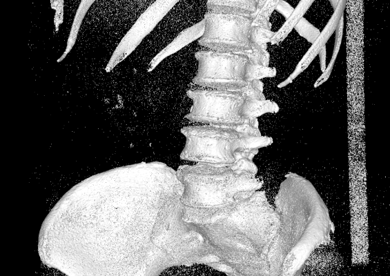 CT Iso-surface